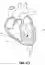 Fig. 09 - Electrode data analysis to indicate catheter stability and/or needle penetration success