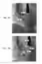 Fig. 23 - Automatic quantitative vessel analysis at the location of an automatically-detected tool