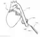 Fig. 01 - Apparatus and method for measuring blood vessels