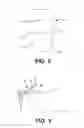 Fig. 03 - Ingrown nail correcting device
