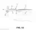 Fig. 10 - Ingrown nail correcting device
