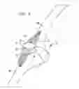 Fig. 02 - MIS PATELLAR PREPARATION