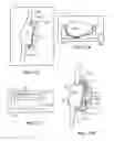 Fig. 33 - Joint arthroplasty devices and surgical tools