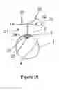 Fig. 04 - MARKER ATTACHING DEVICE FOR ATTACHING A MARKER DEVICE