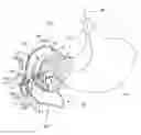 Fig. 01 - METHODS OF SURGICALLY MODIFYING THE DUODENUM