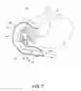Fig. 07 - METHODS OF SURGICALLY MODIFYING THE DUODENUM