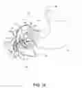 Fig. 16 - METHODS OF SURGICALLY MODIFYING THE DUODENUM
