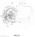 Fig. 20 - METHODS OF SURGICALLY MODIFYING THE DUODENUM