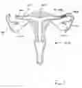 Fig. 02 - Devices and methods for reversal of permanent sterilization