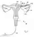 Fig. 06 - Devices and methods for reversal of permanent sterilization