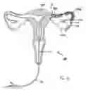 Fig. 07 - Devices and methods for reversal of permanent sterilization