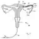 Fig. 08 - Devices and methods for reversal of permanent sterilization