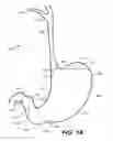 Fig. 02 - DEVICES, METHODS, AND KITS FOR GASTROINTESTINAL PROCEDURES