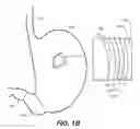 Fig. 03 - DEVICES, METHODS, AND KITS FOR GASTROINTESTINAL PROCEDURES