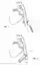 Fig. 02 - SYSTEMS, APPARATUSES, AND METHODS FOR CARDIOVASCULAR CUTTING DEVICES AND VALVES