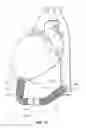 Fig. 08 - SYSTEMS, APPARATUSES, AND METHODS FOR CARDIOVASCULAR CUTTING DEVICES AND VALVES