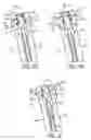 Fig. 06 - Variable tension spine fixation rod