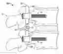 Fig. 01 - SYSTEMS AND METHODS FOR PEDICLE SCREW-BASED SPINE STABILIZATION USING FLEXIBLE BANDS