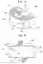 Fig. 09 - Insertion tool for inter-body vertebral prosthetic device with self-deploying screws
