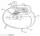 Fig. 38 - Tuned energy balanced system for minimizing heating and/or to provide EMI protection of implanted leads in a high power electromagnetic field environment