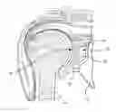 Fig. 01 - Shoulder prosthesis with vault-filling structure having bone-sparing configuration