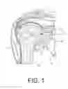 Fig. 02 - Shoulder prosthesis with vault-filling structure having bone-sparing configuration