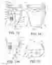 Fig. 08 - Shoulder prosthesis with vault-filling structure having bone-sparing configuration