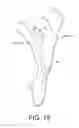 Fig. 09 - Shoulder prosthesis with vault-filling structure having bone-sparing configuration