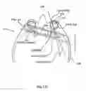 Fig. 30 - Orthovoltage radiotherapy