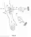 Fig. 44 - Orthovoltage radiotherapy