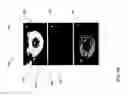 Fig. 06 - QUANTITATIVE SINGLE IMAGE-BASED MAGNETIZATION TRANSFER WEIGHTED IMAGING USING AN INTER-SUBJECT NORMALIZATION REFERENCE WITHIN THE IMAGE