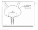 Fig. 01 - APPARATUS AND METHODS FOR TREATING URETHRAL INCONTINENCE