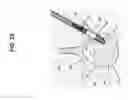 Fig. 26 - Method, Implant & Instruments for Percutaneous Expansion of the Spinal Canal
