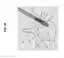 Fig. 27 - Method, Implant & Instruments for Percutaneous Expansion of the Spinal Canal