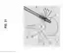 Fig. 28 - Method, Implant & Instruments for Percutaneous Expansion of the Spinal Canal