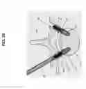 Fig. 30 - Method, Implant & Instruments for Percutaneous Expansion of the Spinal Canal