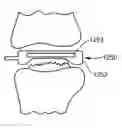 Fig. 01 - Joint arthroplasty devices and surgical tools