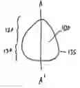 Fig. 01 - Spray method for forming shells for prostheses