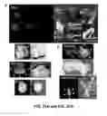 Fig. 49 - Methods and compositions for synaphically-targeted treatment for cancer