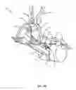 Fig. 11 - Surgical access system and related methods