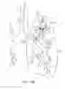 Fig. 20 - Pulmonary occlusal stent delivery catheter, loading system and methods of use