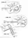 Fig. 14 - METHODS FOR PLACING MATERIALS INTO BONE