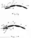 Fig. 02 - APPARATUS AND METHODS FOR CORRECTION OF ORTHODONTIC MALOCCLUSIONS