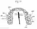 Fig. 12 - APPARATUS AND METHODS FOR CORRECTION OF ORTHODONTIC MALOCCLUSIONS