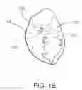 Fig. 03 - Devices and methods for assisting heart function