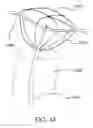 Fig. 10 - Devices and methods for assisting heart function