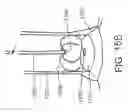 Fig. 23 - Devices and methods for assisting heart function