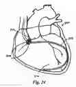 Fig. 34 - Devices and methods for assisting heart function
