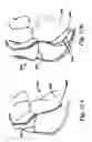 Fig. 41 - Devices and methods for assisting heart function
