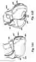 Fig. 42 - Devices and methods for assisting heart function